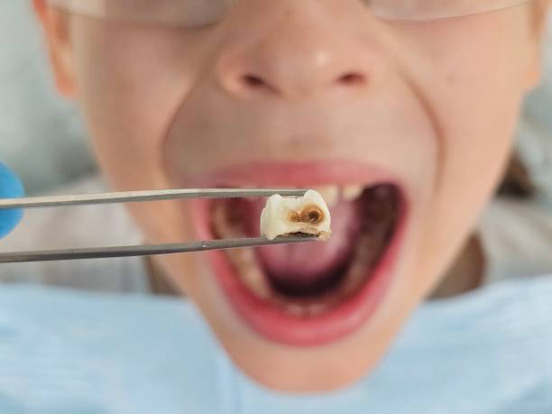 Best Emergency Treatment for Dental Infections or Abscesses in Goodlettsville, TN